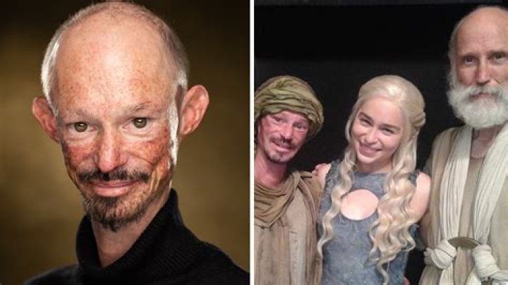 Darren Kent Disability: What Was Wrong With His Face And Skin?