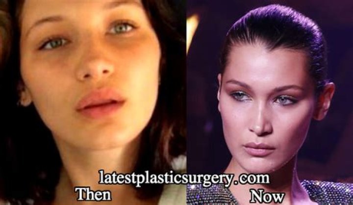 Did Rick Ness Undergo Rhinoplasty?