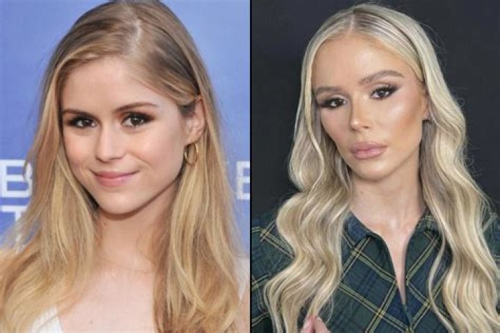 Phoebe Dynevor's Plastic Surgery Journey Explored